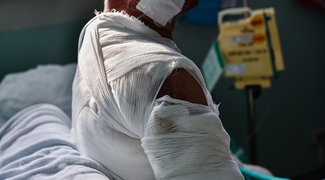 Patient in burn ward with bandages covering injuries